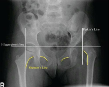 <ul><li><p>AP views</p></li><li><p>evaluated with Perkin’s, Hilgenreiner’s, Shenton’s line</p></li></ul><p></p>