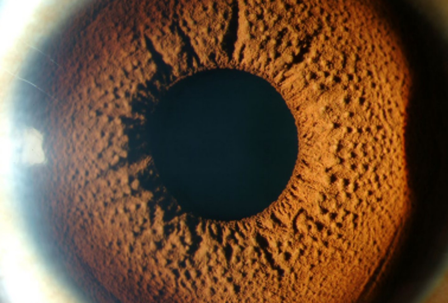 <p>diffuse, tiny villiform lesions of the iris which can be sporadic or autosomal dominant. Are uniform differentiating it from Cogan Reese syndrome</p>