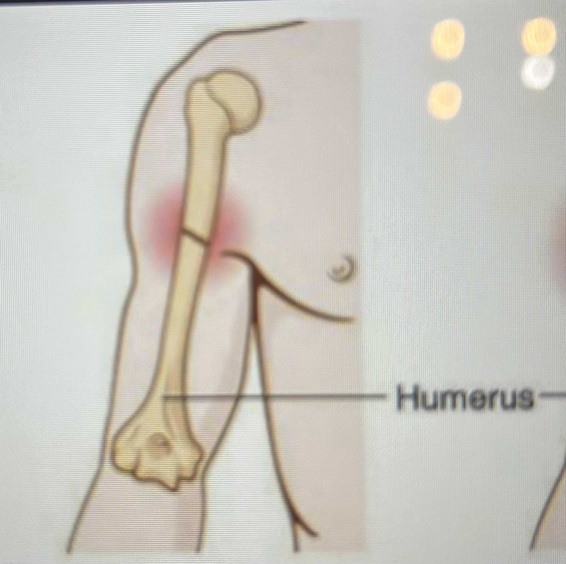 <p>What type of fracture is this?</p>