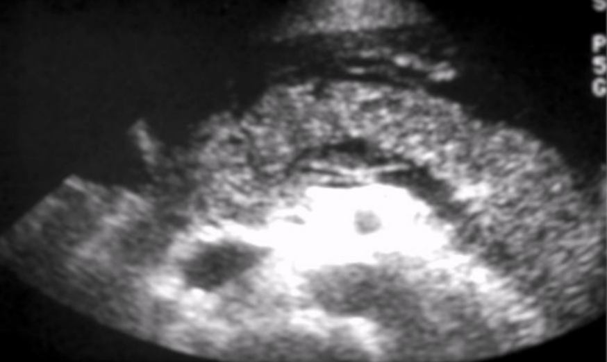 <ul><li><p><span style="background-color: transparent;">Rapid progression of acute pancreatitis</span></p></li><li><p><span style="background-color: transparent;">Destruction of parenchyma by pancreatic enzymes</span></p></li><li><p><span style="background-color: transparent;">Causes: alcoholic binge or large meal</span></p></li><li><p><span style="background-color: transparent;">Characteristic: bleeding necrosis and paralysis of digestive tract</span></p><ul><li><p><span style="background-color: transparent;">Focal fat necrosis or extravasated blood may be visualized</span></p></li></ul></li><li><p><span style="background-color: transparent;">Grey-Turner sign </span></p></li><li><p><span style="background-color: transparent;">High mortality rate</span></p></li></ul><p></p>