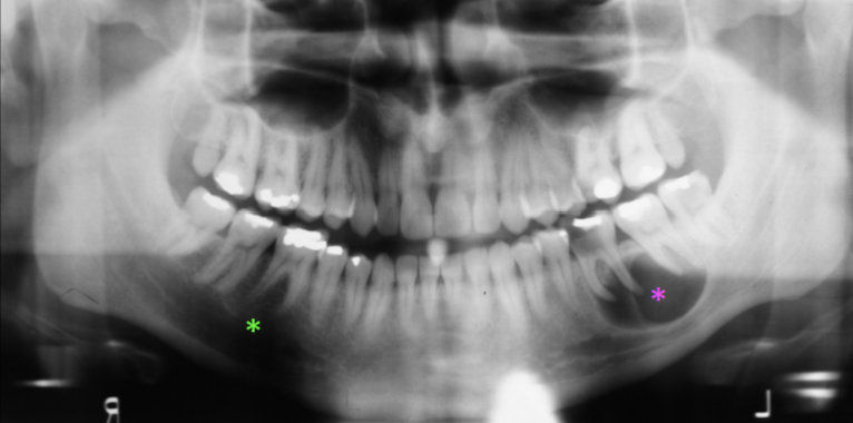 <p><strong>Submandibular Fossa</strong></p>