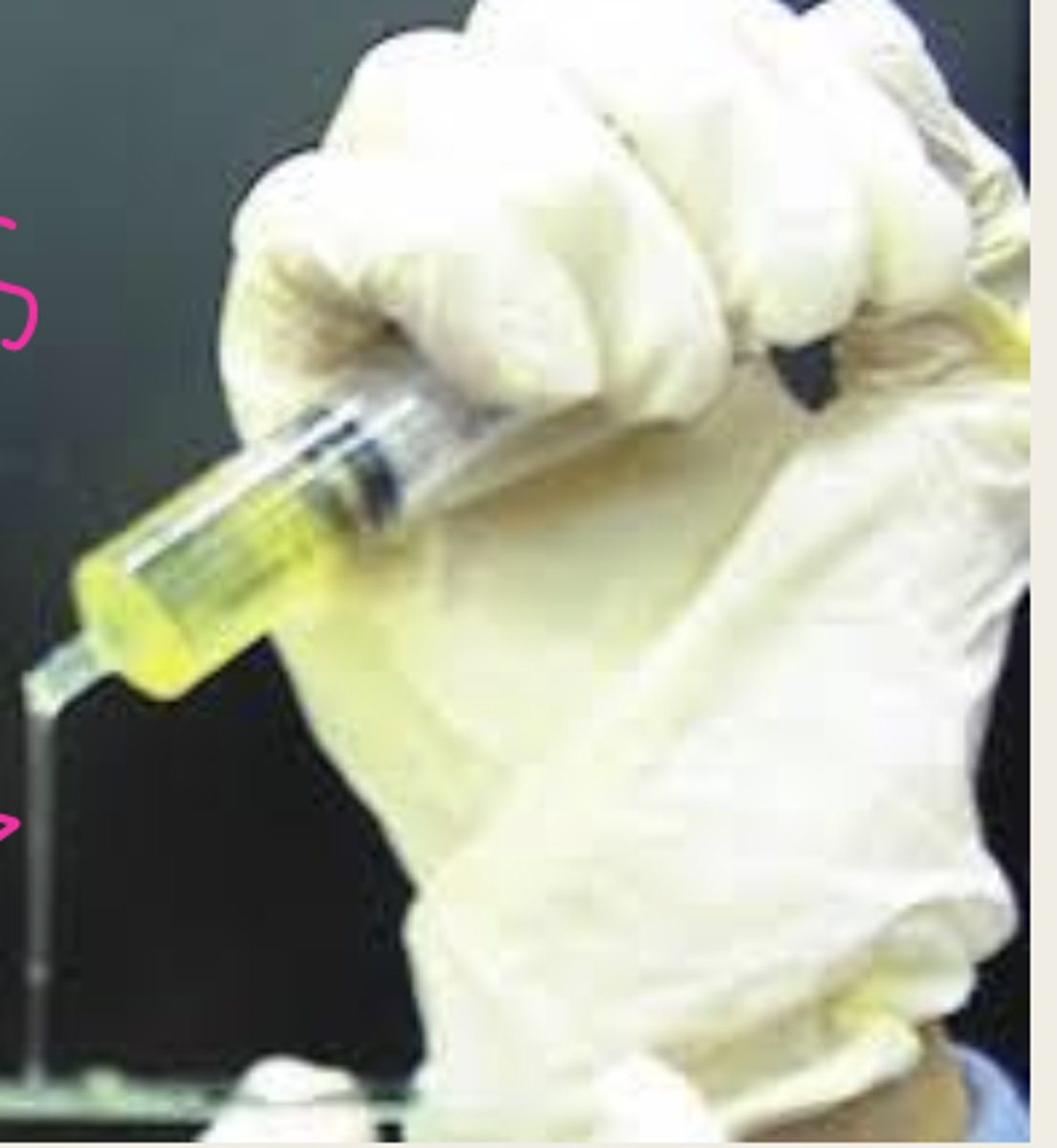 <p>positive (synovial fluid should be viscous)</p>