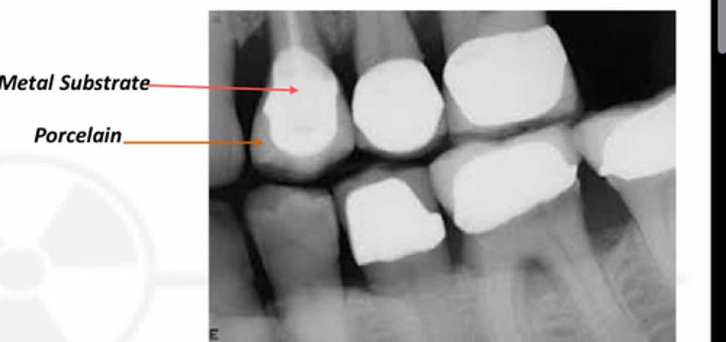 <p>__ looks brighter in radiograph than the overlying porcelain</p>