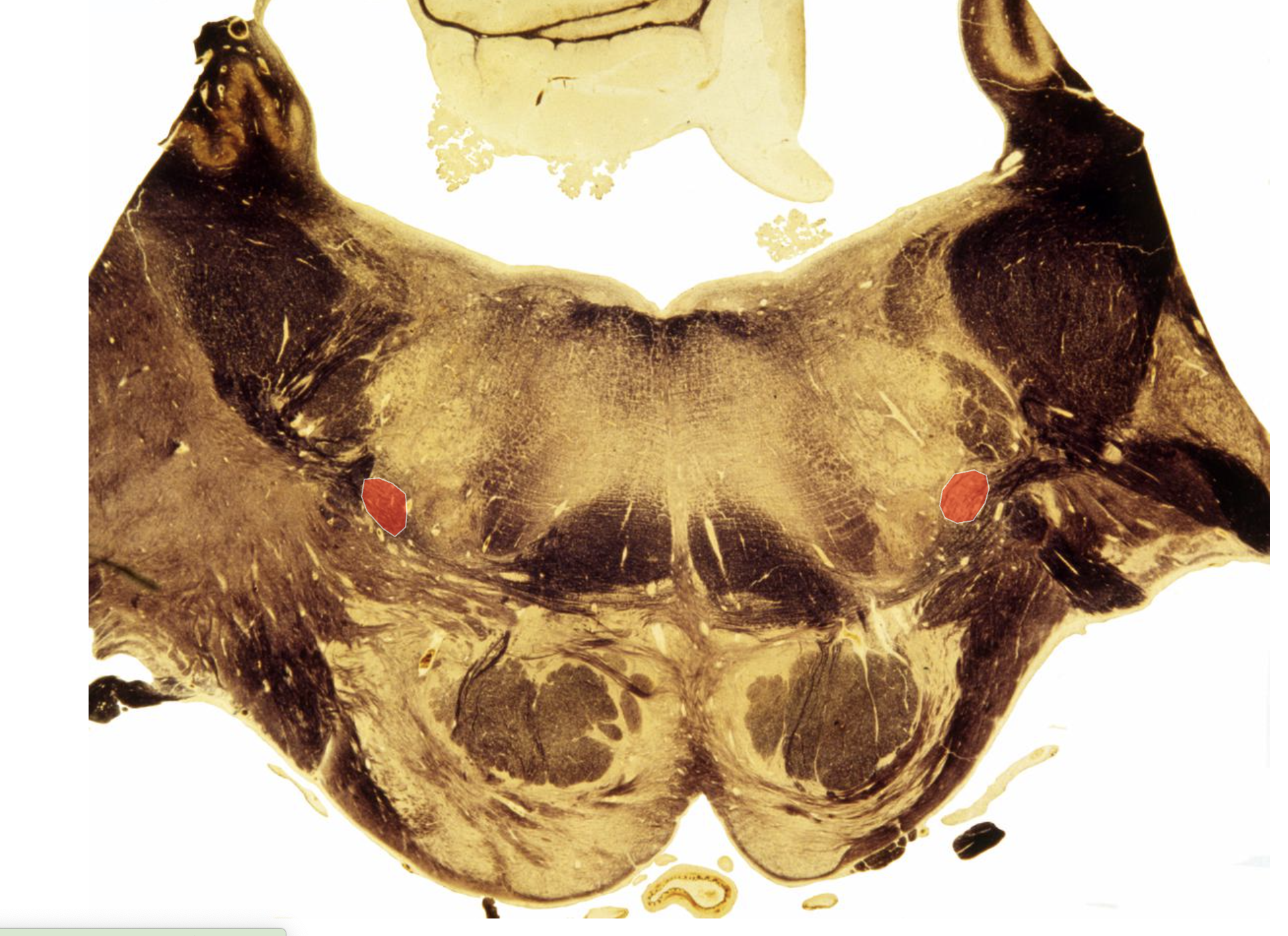<p>Spinothalamic Tract </p><p>(is in same location as caudal spinothalamic, just appears different due to Middle cerebellar peduncle)</p>