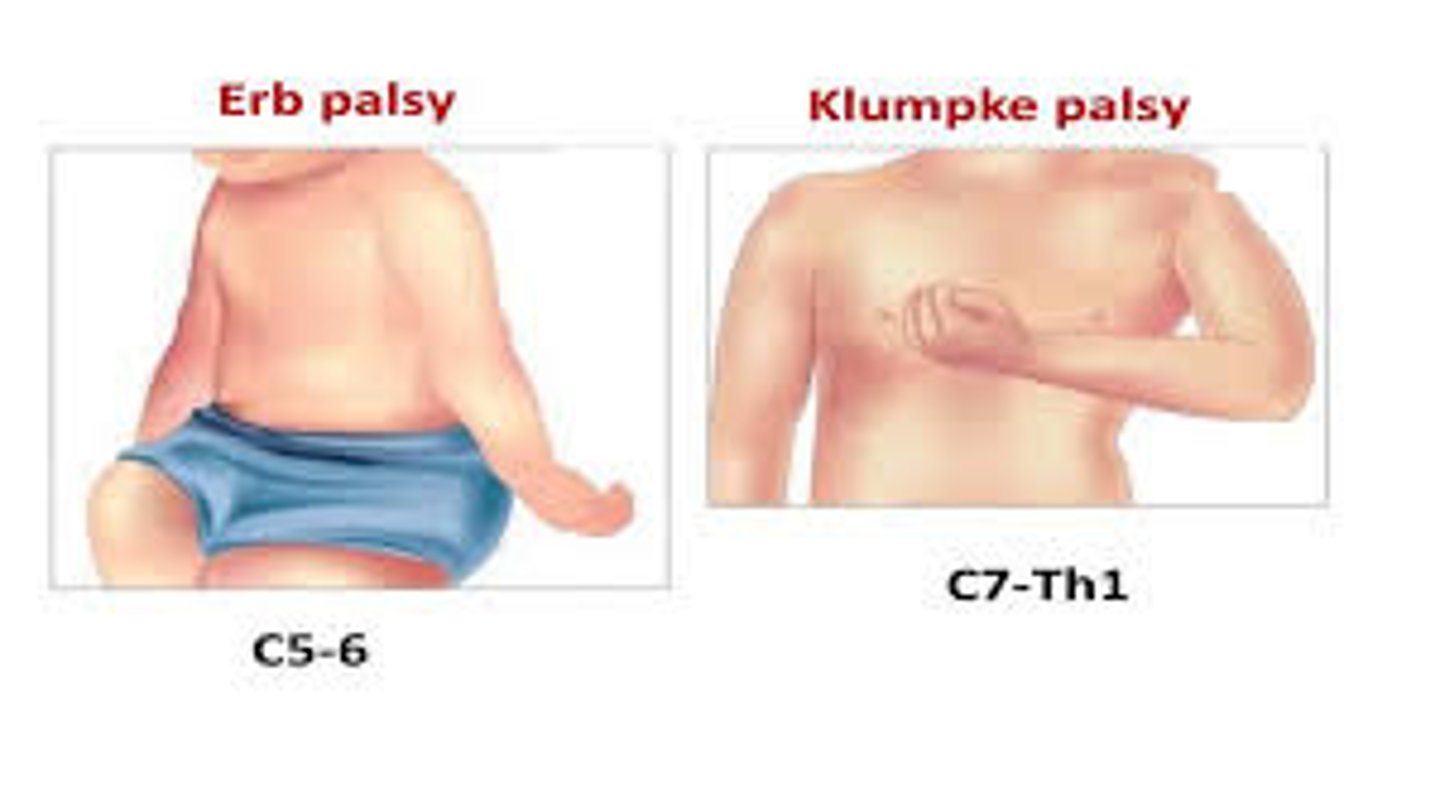 <p>Klumpke's palsy</p><p>MOI - excessive upward pull of UE, traction on lower brachial plexus</p><p>- forearm supinated, elbow flexed, clawing of hand</p>