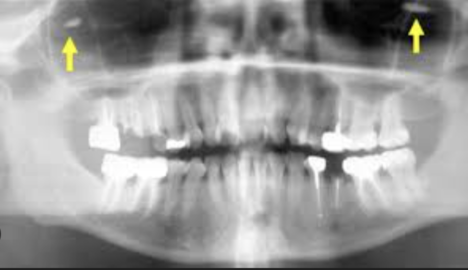 <p>When a body structure in a radiograph is projected on both sides as mirror images. They will have similar proportions and be in the same location. It will only be seen on midline objects.</p>