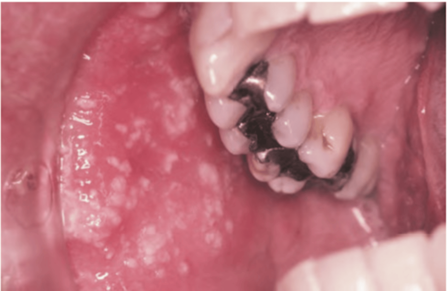 <p>Hint: involve moveable and bound mucosa; teeth may develop pulpitis; bone necrosis with tooth loss</p>