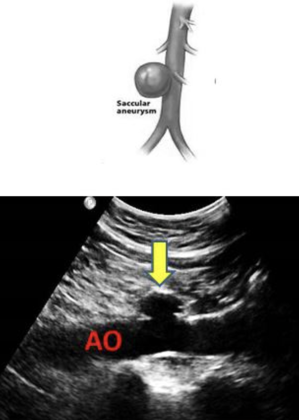 <ul><li><p>localized dilation of vessel</p></li></ul><ul><li><p>spherical structure connected by a vascular mouth</p></li></ul><p></p>