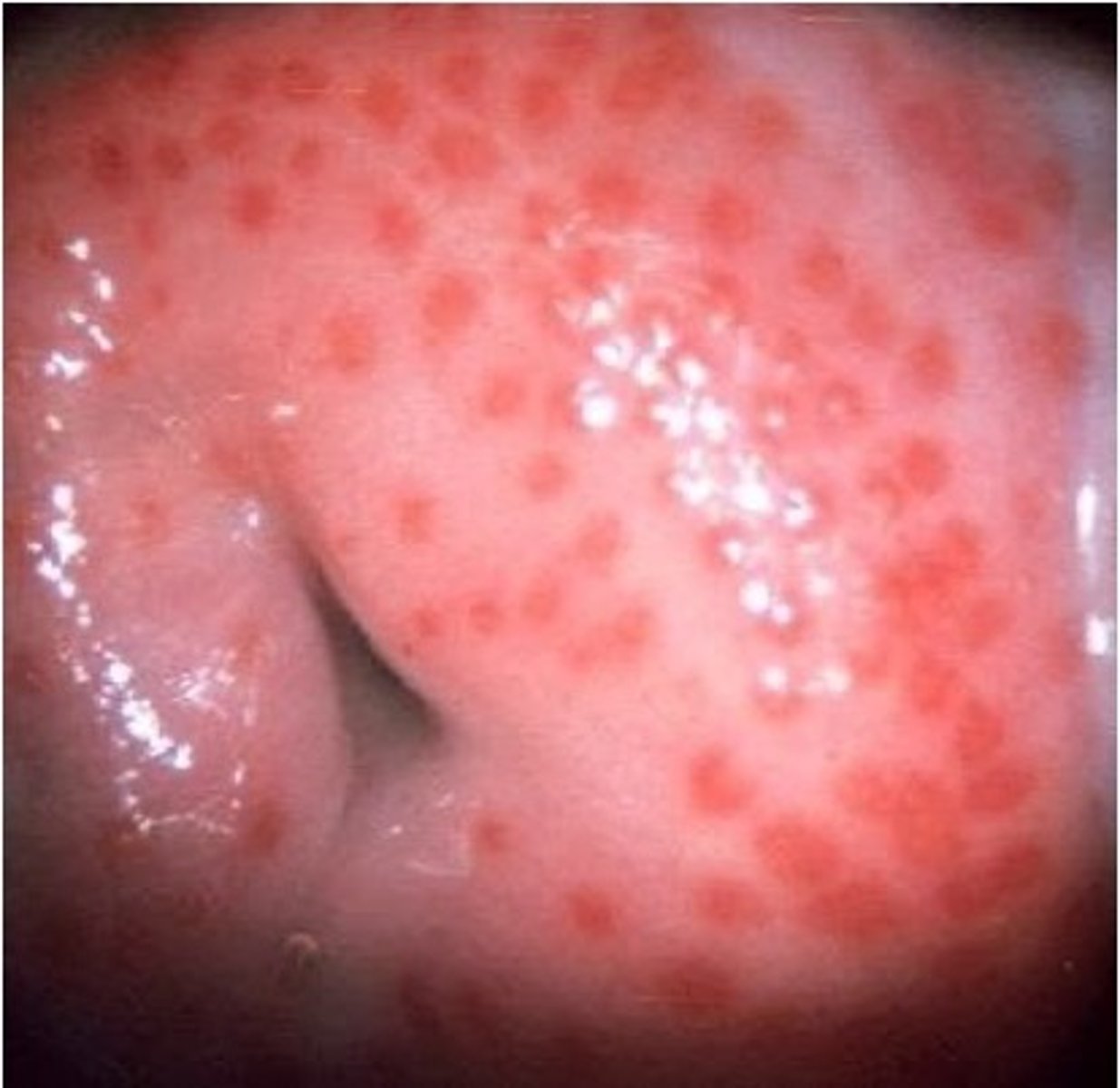 <p>strawberry cervix</p>
