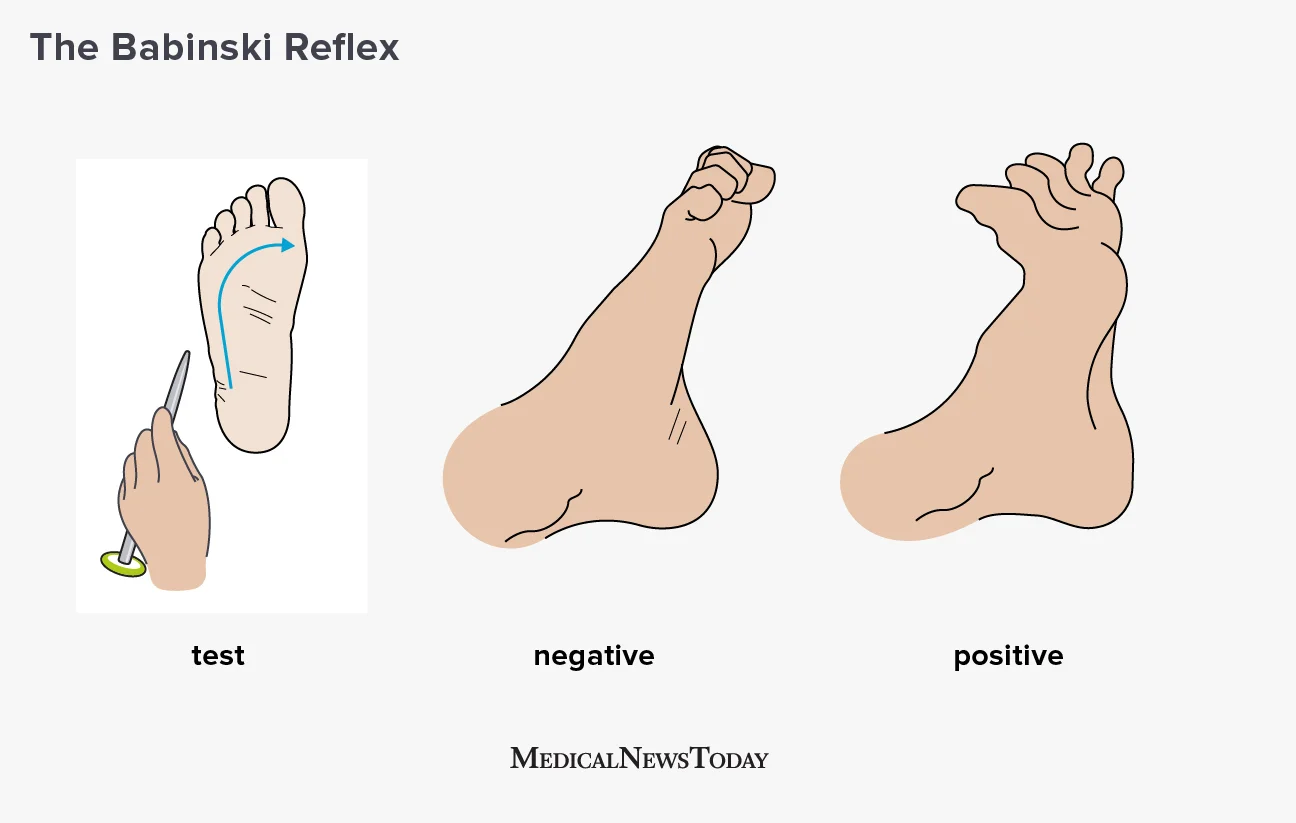 <p>babinsky reflex </p>