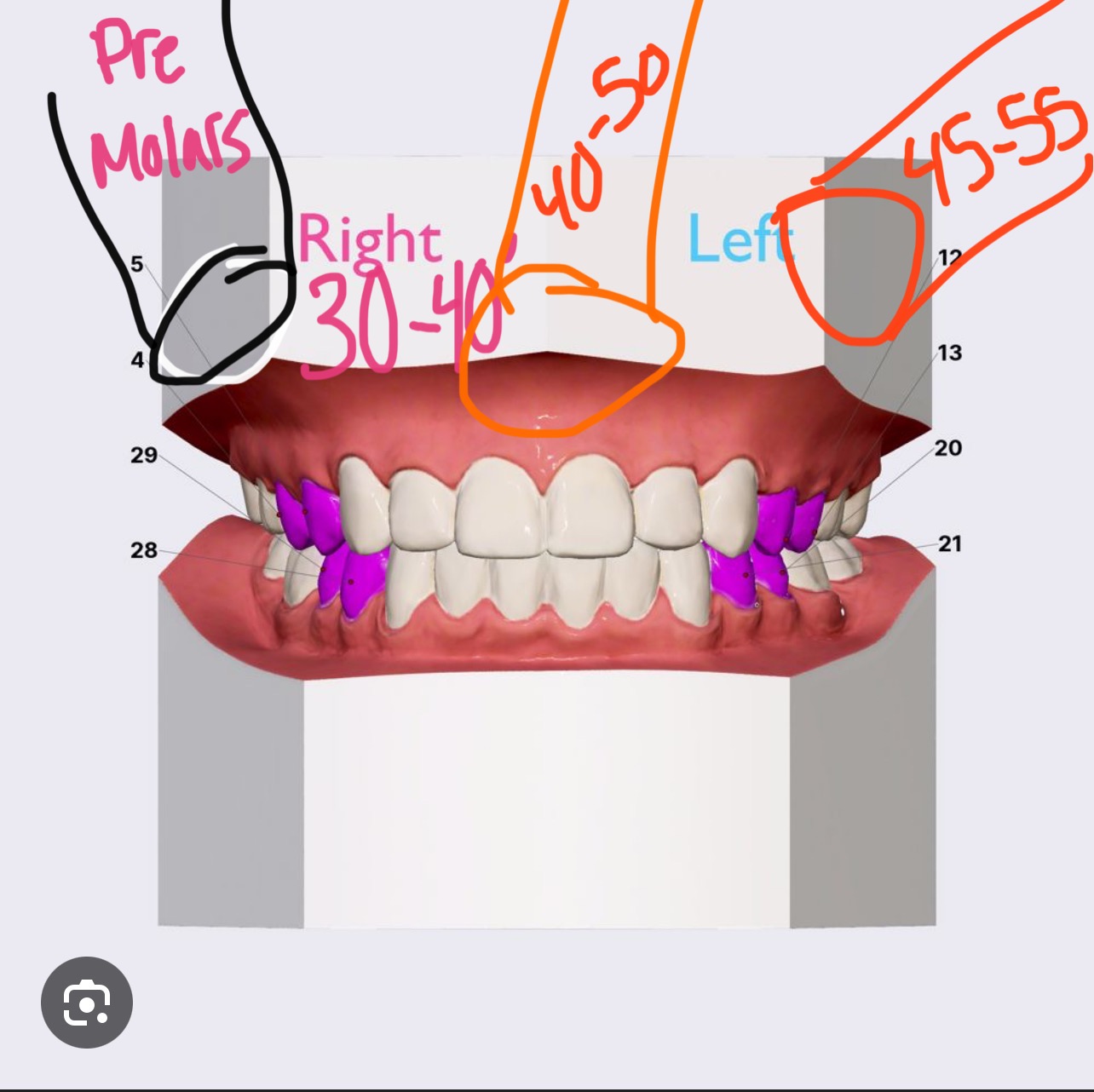 <p></p><ul><li><p>Maxillary (upper) teeth angle</p><ul><li><p>Premolars</p><p></p></li></ul></li></ul><p></p>