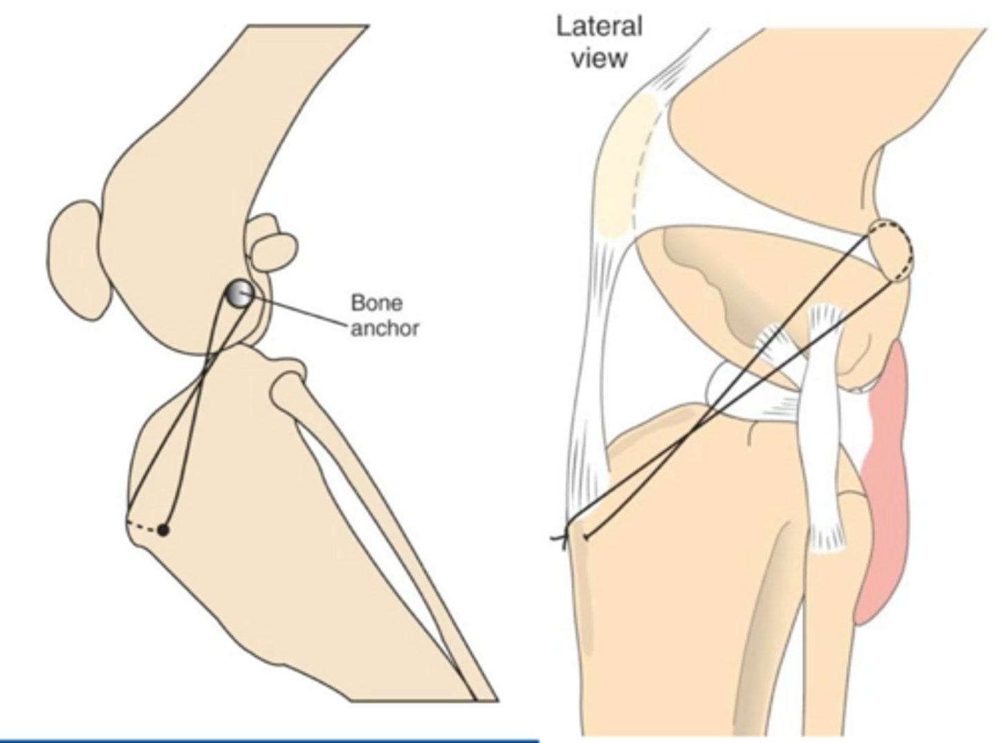 <p>what materials are often used in extracapsular sutures</p>