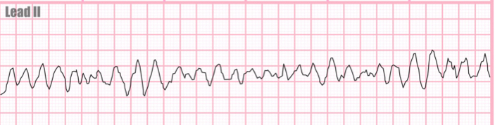 <p>An erratic quivering of the ventricular muscle resulting in no cardiac output </p><p>Multiple ectopic foci are firing </p>