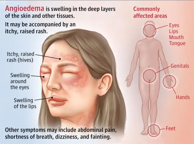 <p>PP: localized subcutaneous/submucosal swelling in deep layers of skin+other tissues<br>-benign</p><p>E: intravascular fluid→leaks into tissue</p><p>P: resolves 24-48 hrs</p>