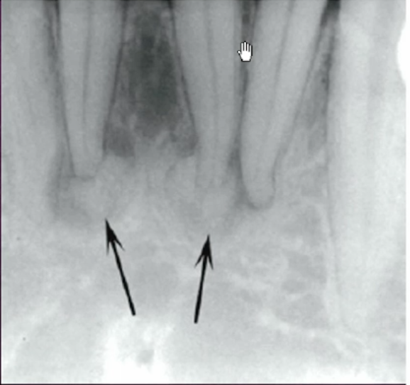 <p>how would describe the border of this lesion </p>