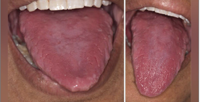 <ol><li><p>Angular cheilitis</p></li><li><p>Atrophic tongue</p></li><li><p>Glossitis</p></li><li><p>Burning sensation maybe due to candidiasis</p></li></ol><p></p>