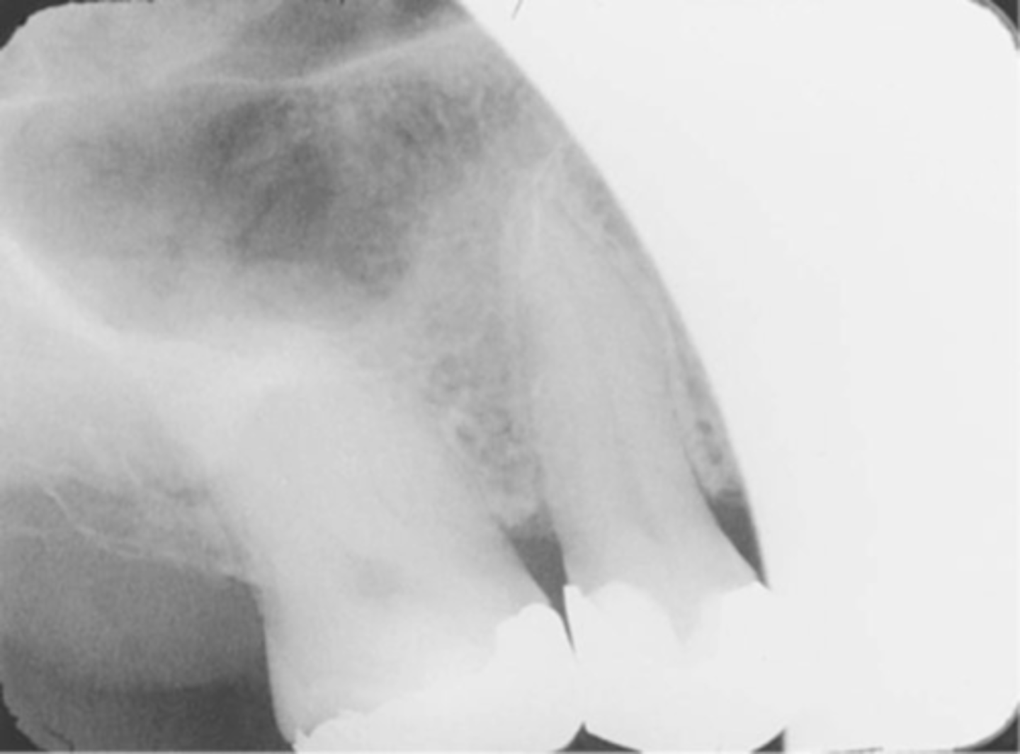 <p>-A clear unexposed area is seen</p><p>-PID was not directed at the center of the receptor, resulting in a clear unexposed area resembling the outline of the PID</p><p>-To avoid position the PID and the x-ray beam centered over the receptor and that the entire receptor is covered by the diameter of the PID</p>