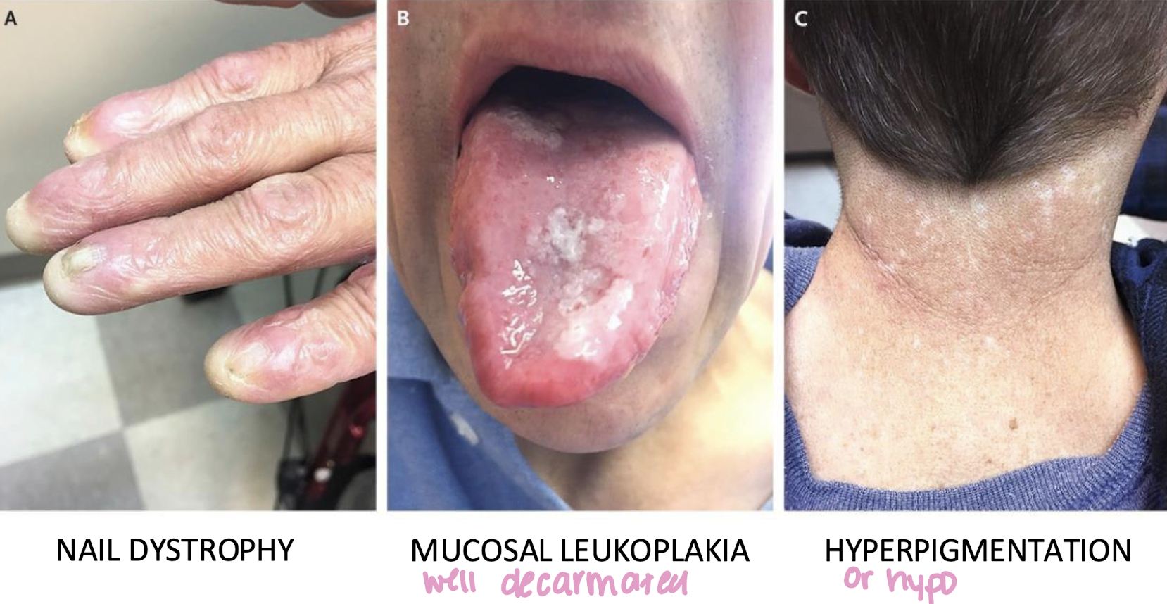 <p>relevant to white lesion lecture, 30 yo w (pre)cancer diagnosis </p>