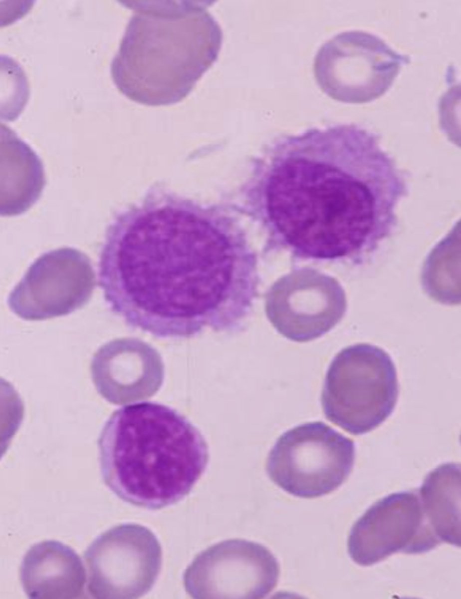 <p>Neoplastic proliferation of mature B cells in BM</p><p>- cells have filaments, making them look hairy</p><p>- affects spleen, BM tap usually dry</p><p>- monocytopenia</p><p>- CD19, 20, 25!, 103!</p>