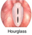 <p>Lesions touch in the mid 1/3 portion of the membranous glottic</p>