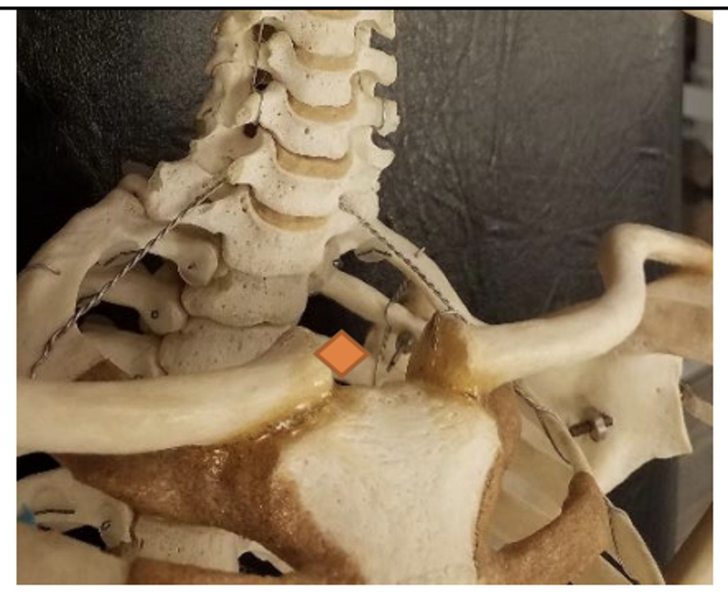 <p>medial to SC joint</p>