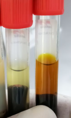 <p><span style="color: red">Jaundice is classified by <strong>site of dysfunction</strong>:</span><br><span style="color: yellow">• <strong>Prehepatic</strong> </span>– excess RBC destruction → ↑ unconjugated bilirubin<br><span style="color: yellow">• <strong>Hepatic</strong></span> – impaired conjugation or hepatocellular injury<br><span style="color: yellow">• <strong>Posthepatic</strong></span><span style="color: #ff8484"> </span>– bile duct obstruction → ↑ conjugated bilirubin buildup</p>