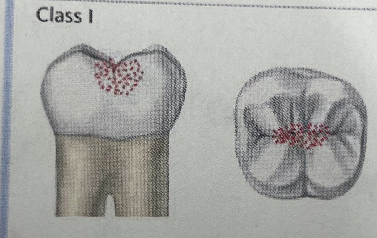 <p>Decay in pits and fissures of molars and premolars and/or in lingual pit of max incisor</p>