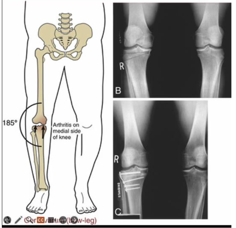 <ul><li><p>High tibial (wedge) osteotomy</p></li><li><p>valgus knee brace</p></li><li><p>lateral wedge insole</p></li><li><p></p></li><li><p>gait modification</p></li><li><p>decrease walking speed</p></li><li><p>strengthen glute max &amp; TFL</p></li></ul><p></p>
