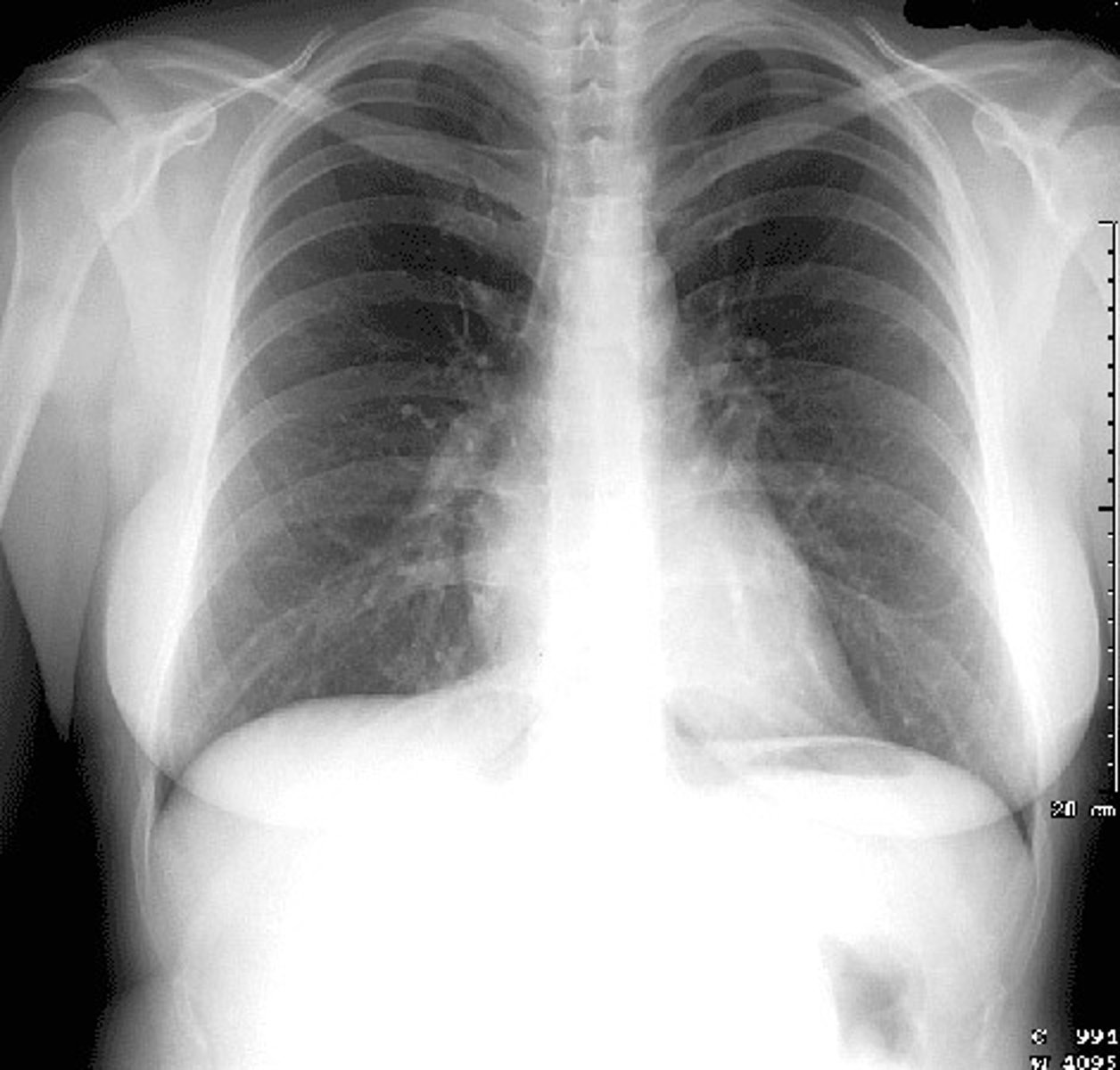 <p>breast tissue</p>