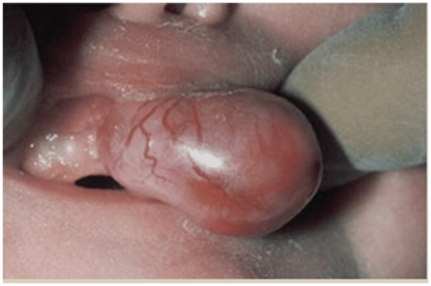 <p>• Pink-to-red, smooth-surfaced,</p><p>polypoid mass on the alveolar</p><p>ridge of a newborn</p><p>• More common on the maxilla</p><p>than the mandible</p><p>• 90% occur in females</p>