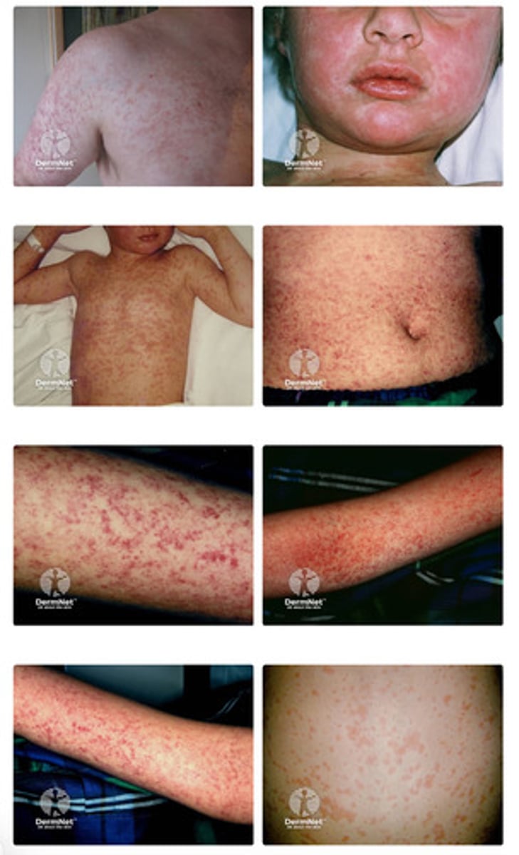 <p>fever, cough, runny nose, and maculopapular rash</p>