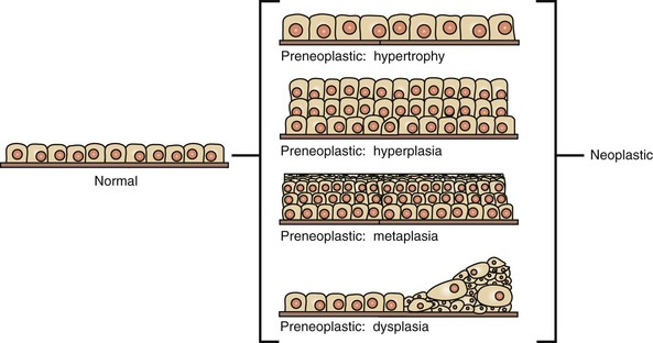 <p>disordered growth, loss of uniformity and loss or architectural orientation</p>