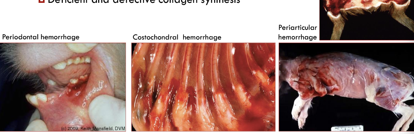 <p>deficient &amp; defective collagen synthesis → bone, connective tissue, blood vessels (capillary fragility)</p>