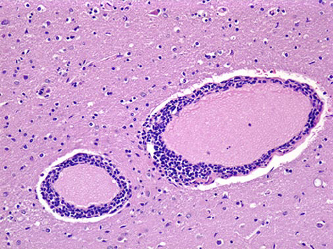 <ul><li><p><u>Marked hyperemia of B.V</u> of leptomeninges</p></li><li><p><u>Micro-abscesses</u></p></li><li><p><u>Perivascular cuffing</u> of mononuclear cells (lymphocytes, plasma cells)</p><ul><li><p><span>Accumulation of inflammatory cells in the space around a blood vessel</span></p></li></ul></li></ul><p></p>