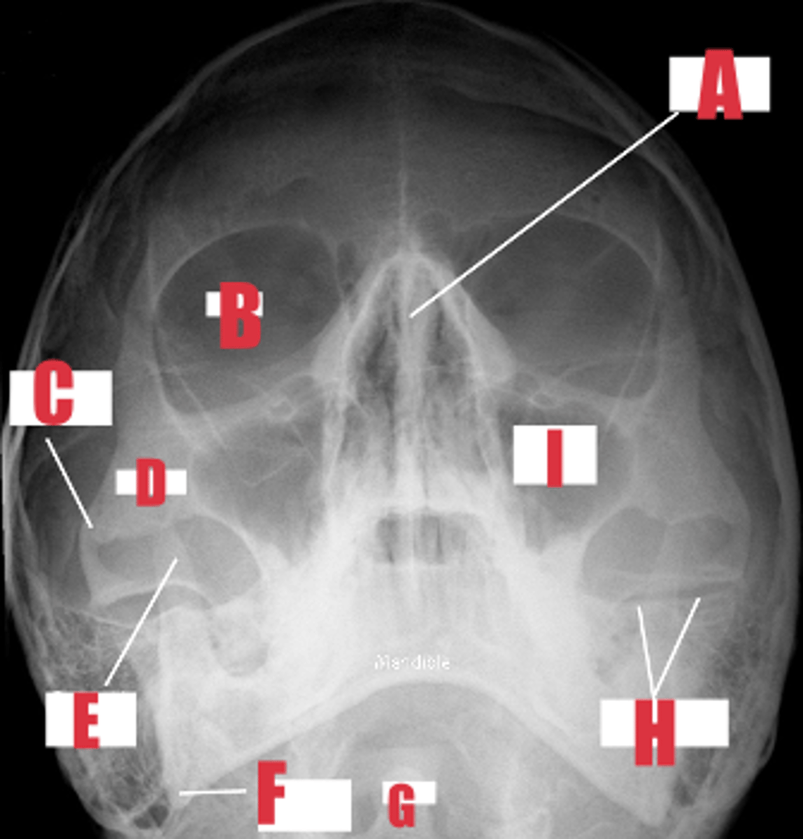<p>what part of bone is A</p>