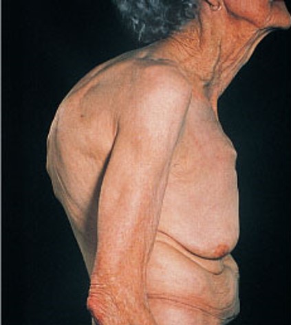 <p>Kyphosis exaggerates the thoracic curvature.</p>