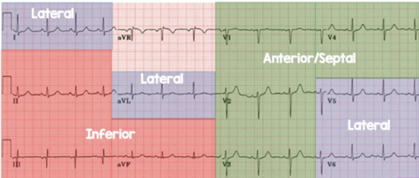 <p>V1, V2, V3, V4</p><p>Left anterior descending artery</p>