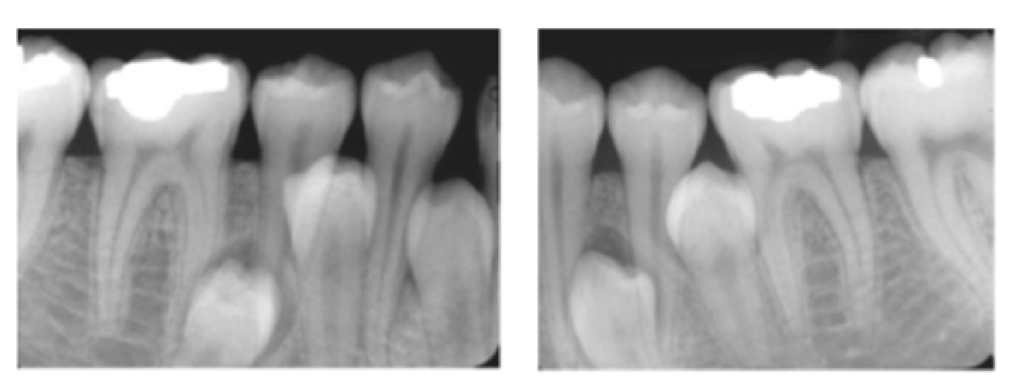 <p>Extra premolar in mandible</p>