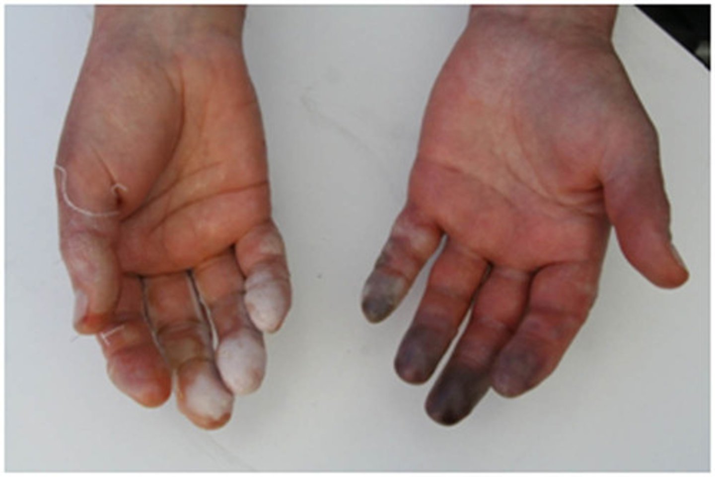 <p>- extremities: eg. fingers, toes, ears, nose, chin</p><p>- overall areas with weaker circulation (peripheral) as capillaries are more thin</p>