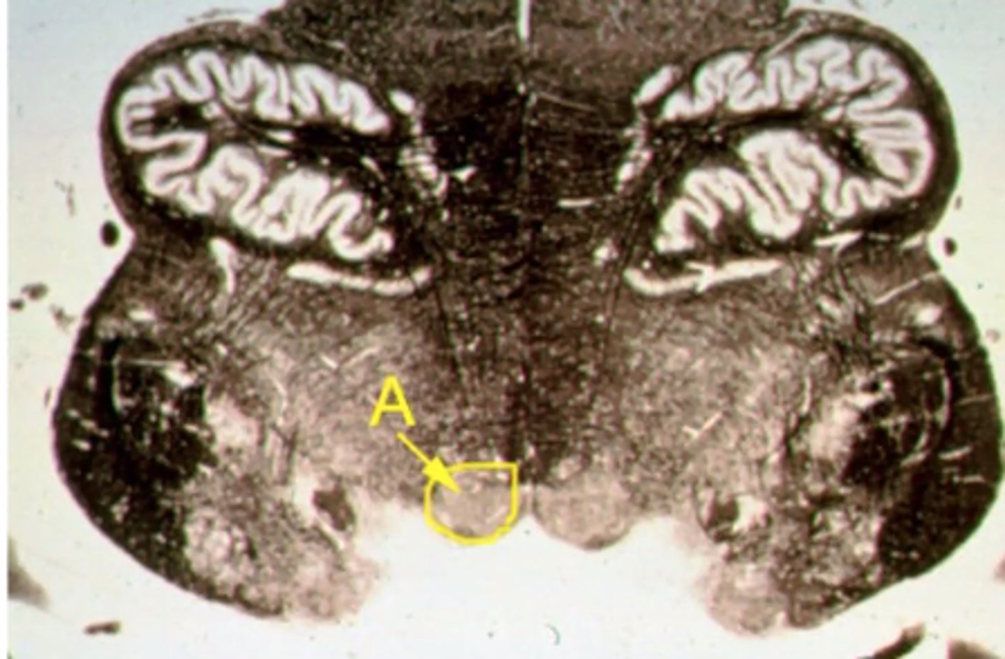<p>A lesion to structure "A" will results in:<br><br>A. The tongue will deviate to the ipsilateral side when protruded <br><br>B. Loss of gustatory sensation <br><br>C. Loss of parasympathetic function <br><br>D. Ipsilateral eye will deviate towards the midline <br><br>E. Ipsilateral loss of pain & temp from the face</p>