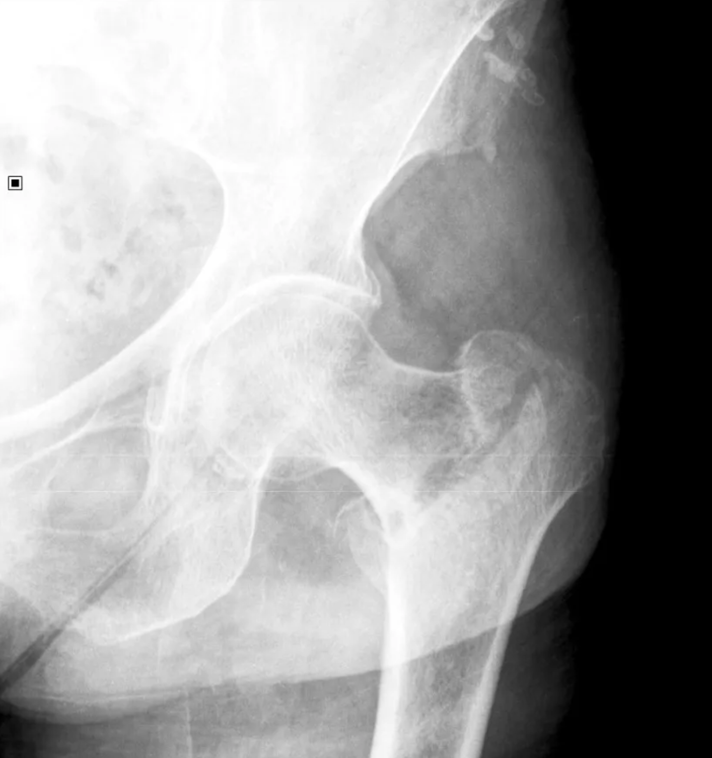 <p>65 year old male:</p><ul><li><p>fall onto left side while getting out of bed</p></li><li><p>AP radiograph of the hip</p></li><li><p>Prior DXR (bone density) scan showed marked osteoporosis</p></li></ul><p></p>