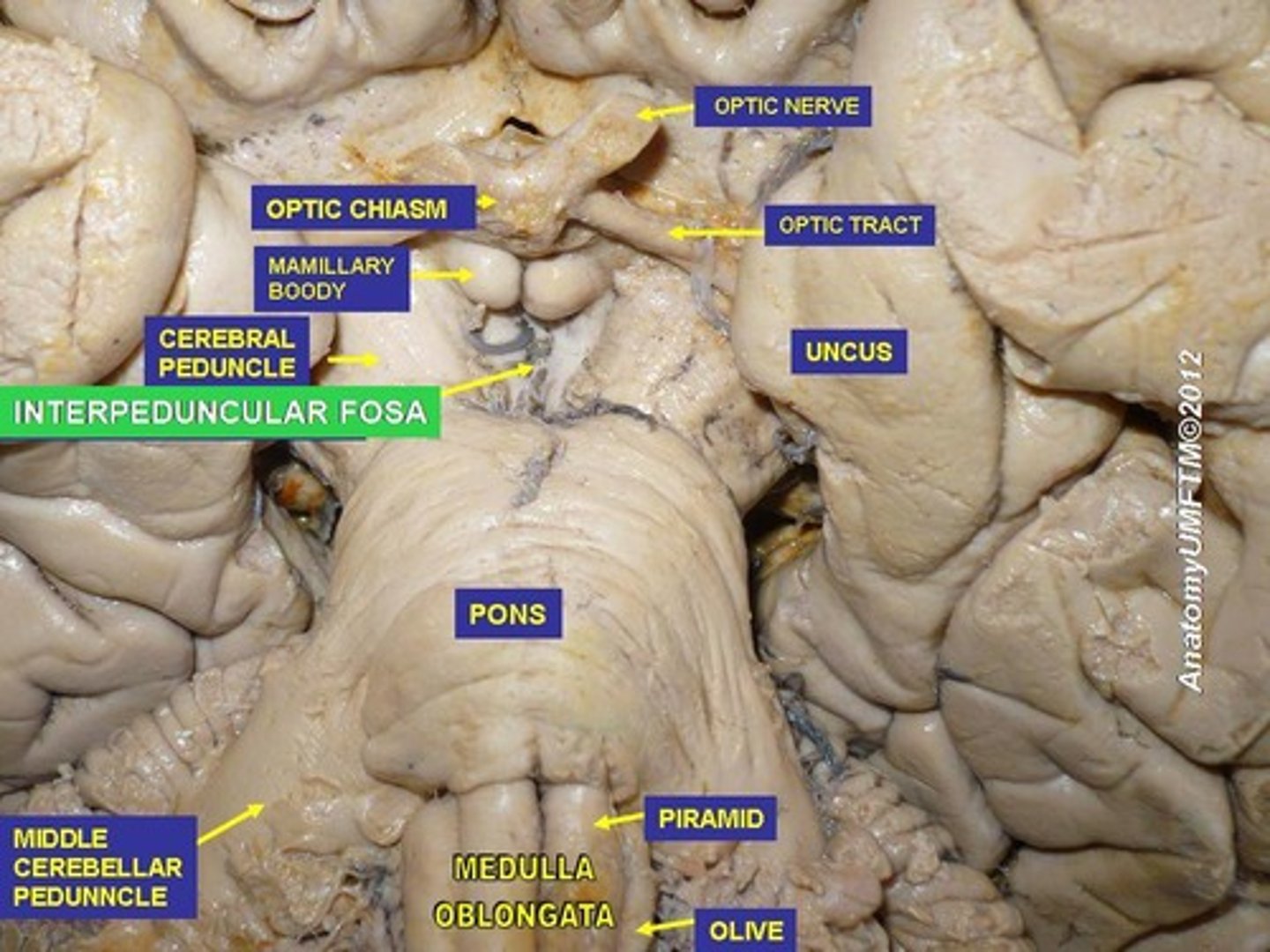 <p>Sulcus oculomotorius (fossa interpeduncularis'es)</p>