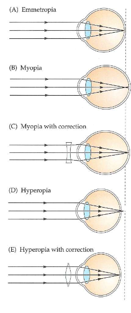 <ul><li><p>emmetropie</p><ul><li><p>brekingsvermogen van 4 optische componenten van oog (hoornvlies, kamerwater, lens &amp; glasvocht) komen perfect overeen met lengte van oogbol</p></li><li><p>geen corrigerende lenzen nodig om objecten in verte te zien</p></li></ul></li><li><p>refractieafwijkingen: wanneer oogbol te lang/ te kort is tov sterkte van 4 optische componenten</p><ul><li><p>oogbol te lang → beeld van ster zal vóór netvlies worden gefocusseerd</p><ul><li><p>ster → wazige vlek</p></li><li><p>myopie = bijziendheid</p></li><li><p>verre objecten niet scherp te zien</p></li><li><p>corrigeren met negatieve (min) lenzen → gaan stralen van sterrenlicht divergeren voordat ze oog binnendringen</p></li></ul></li><li><p>oogbol te kort → beeld van ster achter netvlies gefocusseerd</p><ul><li><p>hyperopie = verziendheid</p></li><li><p>ster → wazige vlek</p></li><li><p>corrigeren met positieve (plus) lenzen → gaan stralen van licht convergeren voordat ze oog binnendringen</p></li></ul></li></ul></li></ul><p></p>