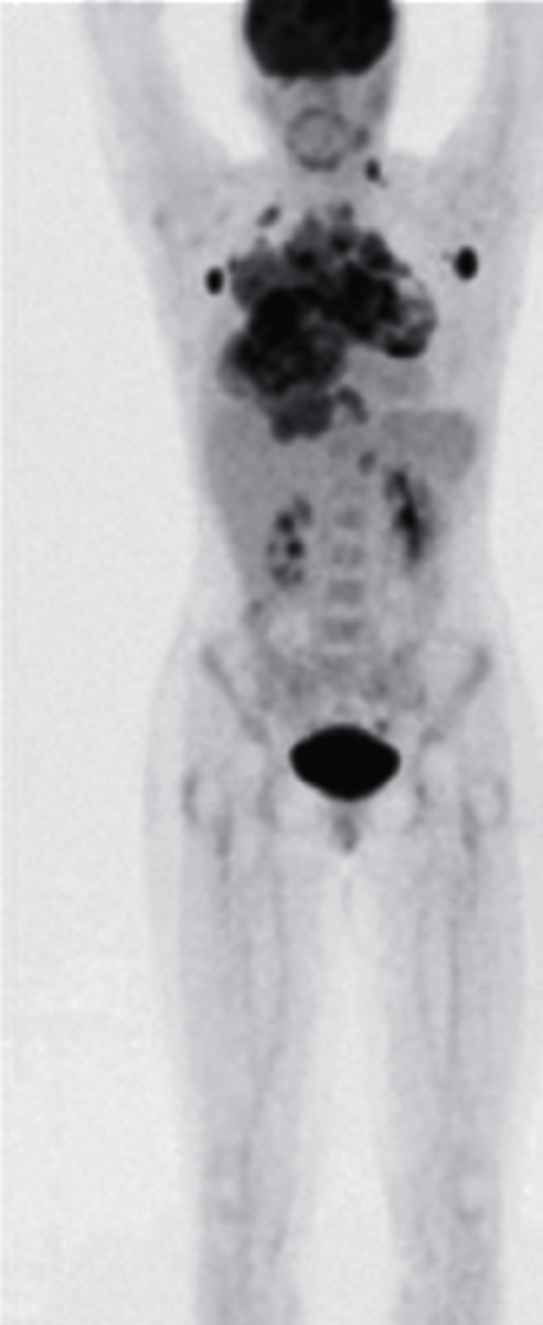 <p>what type of imaging study is this?</p><p>a. Bone Scan</p><p>b. CT scan</p><p>c. PET scan</p><p>d. MRI</p>