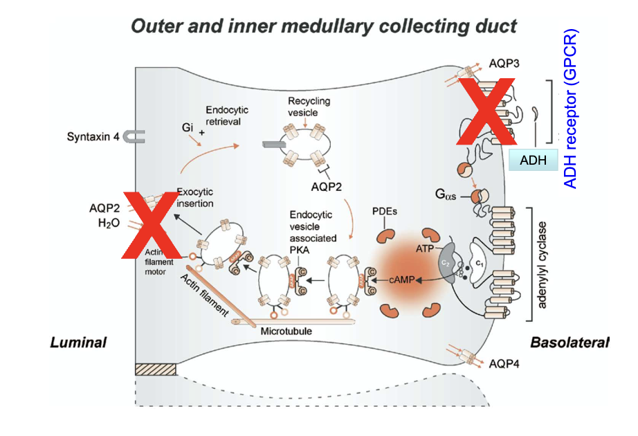 <ul><li><p>Inactivating mutations (mostly Class II) in the ADH receptor gene</p><ul><li><p>221 currently known ADH receptor gene mutations cause XNDI</p></li></ul></li><li><p>Misfolded ADH receptors trapped in the endoplasmic reticulum</p></li><li><p>Loss of ADH signaling → no AQP2 expression or insertion into the luminal membrane</p></li><li><p>Results in impaired water reabsorption in the collecting duct</p></li></ul><p></p>