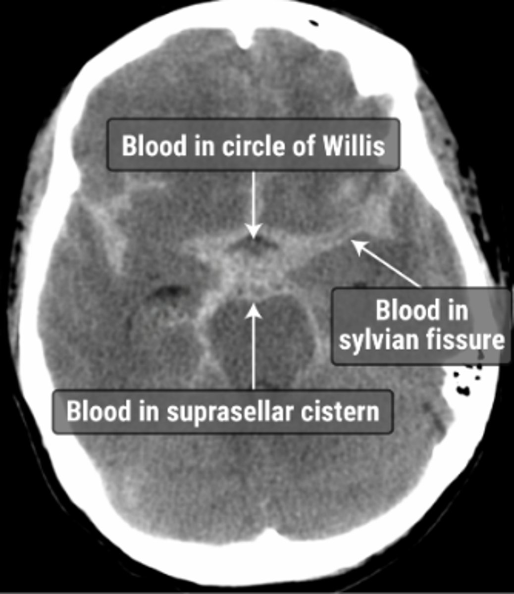 <p>CT scan w/o contrast</p><p>LP--&gt; performed if CT (-)</p><p>•xanthochromia</p><p>Cerebral Angiography (4 vessel)</p><p>- usually performed after confirmed SAH to</p><p>identify source of bleeding &amp; other aneurysms</p>