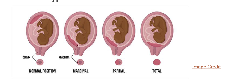 <p>is a condition where the <strong>placenta implants low in the uterus</strong> and <strong>partially or completely covers the cervical os</strong> (the opening of the cervix).</p><p>Risk factors: previous c/s, AMA(advanced maternal age), multiparity, D&amp;C (dilation and curretage), smoking\</p><img src="https://knowt-user-attachments.s3.amazonaws.com/45e35d45-b76c-427e-b51d-523d5cdb845c.png" data-width="100%" data-align="center"><p><strong>symptoms</strong></p><ul><li><p>painless, bright red vaginal bleeding</p></li><li><p>VS may be WDL</p></li><li><p>soft nontender abdomen with NL uterine tone</p></li><li><p>FHR may be WDL until sever detachment</p></li></ul><p></p><table style="min-width: 75px;"><colgroup><col style="min-width: 25px;"><col style="min-width: 25px;"><col style="min-width: 25px;"></colgroup><tbody><tr><th colspan="1" rowspan="1"><p>Feature</p></th><th colspan="1" rowspan="1"><p><strong>Previa</strong></p></th><th colspan="1" rowspan="1"><p><strong>Abruption</strong></p></th></tr><tr><td colspan="1" rowspan="1"><p><strong>Pain</strong></p></td><td colspan="1" rowspan="1"><p>None</p></td><td colspan="1" rowspan="1"><p>Present</p></td></tr><tr><td colspan="1" rowspan="1"><p><strong>Bleeding</strong></p></td><td colspan="1" rowspan="1"><p>Bright red</p></td><td colspan="1" rowspan="1"><p>Dark red</p></td></tr><tr><td colspan="1" rowspan="1"><p><strong>Uterus</strong></p></td><td colspan="1" rowspan="1"><p>Soft</p></td><td colspan="1" rowspan="1"><p>Rigid/tender</p></td></tr><tr><td colspan="1" rowspan="1"><p><strong>Fetal distress</strong></p></td><td colspan="1" rowspan="1"><p>Rare</p></td><td colspan="1" rowspan="1"><p>Common</p></td></tr><tr><td colspan="1" rowspan="1"><p><strong>Delivery</strong></p></td><td colspan="1" rowspan="1"><p>C-section</p></td><td colspan="1" rowspan="1"><p>Often urgent</p></td></tr></tbody></table><p>Concerns</p><p></p>