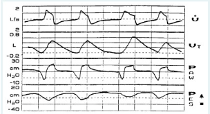 <p>You observe the following graphics display on a patient receiving pressure control A/C ventilation. The most significant problem is:</p><p>a leak in the patient-ventilator system</p><p>inadequate inspiratory flow setting</p><p>improper sensitivity setting </p><p>presence of auto-PEEP/air-trapping </p>
