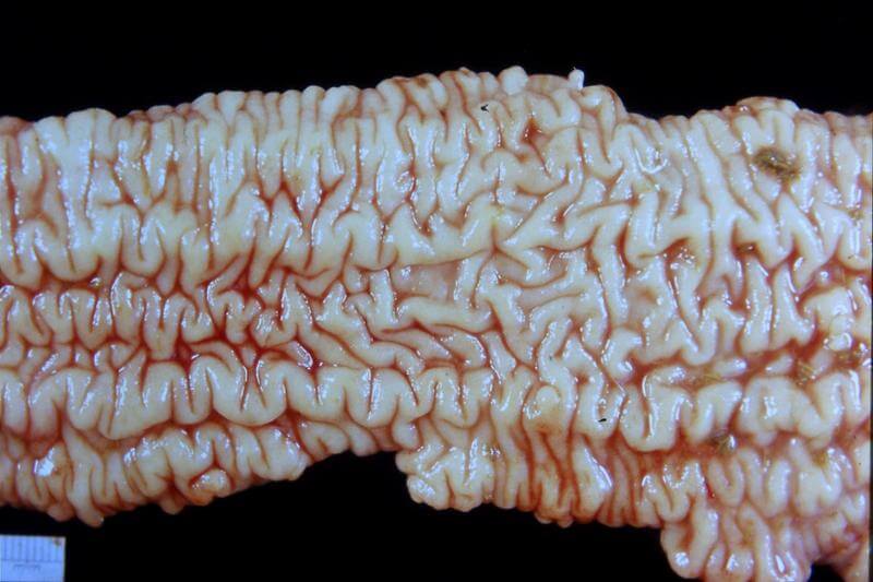 <p><strong><span>Caused by:</span></strong></p><ul><li><p><em><mark data-color="red" style="background-color: red; color: inherit;"><span>M. avium subsp. Paratuberculosis </span></mark></em><span>– John’s disease (similar to Chron`s in humans). </span><mark data-color="red" style="background-color: red; color: inherit;"><span>OiE-notifiable.</span></mark><span><br></span></p></li></ul><p><strong><span>Susceptible species:</span></strong></p><ul><li><p><span>Paratuberculosis (Johne’s disease) is a chronic, contagious bacterial disease of the intestinal tract that affects </span><span style="color: rgb(255, 255, 255);"><mark data-color="red" style="background-color: red; color: inherit;"><span>mainly sheep and cattle, as well as other ruminants </span></mark></span><span>species. It has been reported in other mammals</span></p></li></ul><p><strong>Transmission: </strong></p><ul><li><p><span>Infected animals sheds the bacteria in manure, colostrum and milk.</span></p></li><li><p><strong><span>Ingestion</span></strong><span>: infection is most commonly acquired in young animals through contamination of the </span><mark data-color="red" style="background-color: red; color: inherit;"><span>environment or through ingestion of contaminated milk.</span></mark></p></li><li><p><strong><span>Vertically: </span></strong><span>the disease can also be transmitted from an </span><mark data-color="red" style="background-color: red; color: inherit;"><span>infected animal to its foetus.</span></mark><span> </span></p></li></ul><p><strong>Epizootology:</strong></p><ul><li><p><u><span>Not a zoonosis,</span></u><span> however, is very similar to Chron’s disease in humans. The bacteria has a global distribution and is </span><u><span>very resistant to both heat, cold, and drying.</span></u></p></li><li><p><span>Adult animals are less likely to be infected than </span><em><span>young animals (highly susceptible).</span></em></p></li></ul><p><strong>Clinical signs:</strong></p><ul><li><p><span> Paratuberculosis is a </span><mark data-color="red" style="background-color: red; color: inherit;"><span>slowly progressive disease</span></mark><span>, and clinical signs usually first appear in young<br>adulthood (4-7 years old). </span></p></li></ul><ul><li><p><span>Predisposing factors include stress and poor nutrition.</span></p></li><li><p><span>The bacteria cause </span><mark data-color="red" style="background-color: red; color: inherit;"><span>chronic hypertrophic<br>enteritis characterized by diarrhoea</span></mark><span> (very watery<br>and smelly - look like pea soup), unthrifty<br>animals, low milk yield and </span><mark data-color="red" style="background-color: red; color: inherit;"><span>progressive weight<br>loss despite a good appetite and normal body temperature.</span></mark></p></li><li><p><span>It may also cause what is known as </span><span><span>“</span><strong><span>bottle jaw”</span></strong></span><span>- swelling under the jaw.</span></p></li><li><p><span>The symptoms become gradually more severe and lead to malnutrition and death.</span></p></li></ul><p><strong><span>Pathology:</span></strong></p><ul><li><p><span>The </span><mark data-color="red" style="background-color: red; color: inherit;"><span>primary site of infection is the Ileum</span></mark><span>.</span></p></li><li><p><span>The wall of ileum contains Peyer’s patches containing macrophages which engulf </span><em><span>M. paratuberculosis, but fails to kill it.</span></em><span> </span></p></li><li><p><mark data-color="red" style="background-color: red; color: inherit;"><span>Inside the macrophage, </span></mark><em><mark data-color="red" style="background-color: red; color: inherit;"><span>M. paratuberculosis </span></mark></em><mark data-color="red" style="background-color: red; color: inherit;"><span>multiplies until it kills the cell and infect other cells. </span></mark></p></li><li><p><span>The animal’s immune system reacts to the bacterial invasion by recruiting more macrophages and lymphocytes. </span></p></li><li><p><span>Infiltration of infected tissues with millions of these cells leads to visible thickening of the intestines. </span></p></li><li><p><span>This prevents nutrient absorption and diarrhoea results.<br></span></p></li></ul><p><strong><span>Diagnosis, prevention, treatment:</span></strong></p><ul><li><p><span>Clinical signs, Laboratory tests: faeces, PCR, allergy test, Biopsy</span></p></li><li><p><span>There is </span><mark data-color="red" style="background-color: red; color: inherit;"><span>no known treatment for the disease.</span></mark></p></li><li><p><span>Control involves good sanitation and management practices including screening tests and surveillance</span></p></li></ul><p></p>