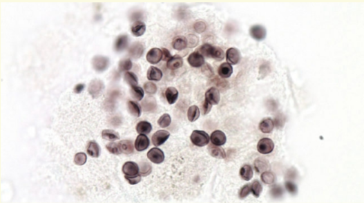 <p><span style="color: #f5f4f4">Originally thought to be a protozoan</span><span style="color: #f5f4f4"><br></span><span style="color: #f5f4f4">4 Nonfilmanetous fungus</span><span style="color: #f5f4f4"><br></span><span style="color: #f5f4f4">4 Pneumonia -immunocompromised patients</span><span style="color: #f5f4f4"><br></span><span style="color: #f5f4f4">– Non-productive cough, fever, difficulty breathing</span><span style="color: #f5f4f4"><br></span><span style="color: #f5f4f4">4 Live stages still referred to by protozoan names; trophozoite, precyst</span><span style="color: #f5f4f4"><br></span><span style="color: #f5f4f4">and cyst</span><span style="color: #f5f4f4"><br></span><span style="color: #f5f4f4">– Cyst is the infective stage via respiratory transmission</span><span style="color: #f5f4f4"><br></span><span style="color: #f5f4f4">4 P. carinii and P. jirovecii most prevalent species</span><span style="color: #f5f4f4"><br></span><span style="color: #f5f4f4">4 Specimen Source: Bronchoalveolar Lavage Fluid or Bronchial</span><span style="color: #f5f4f4"><br></span><span style="color: #f5f4f4">Washings or Induced Sputum</span><span style="color: #f5f4f4"><br></span><span style="color: #f5f4f4">4 Specimen is prepared, cytospun and fixed onto a slide for staining with</span><span style="color: #f5f4f4"><br></span><span style="color: #f5f4f4">silver stain or alternate</span></p>